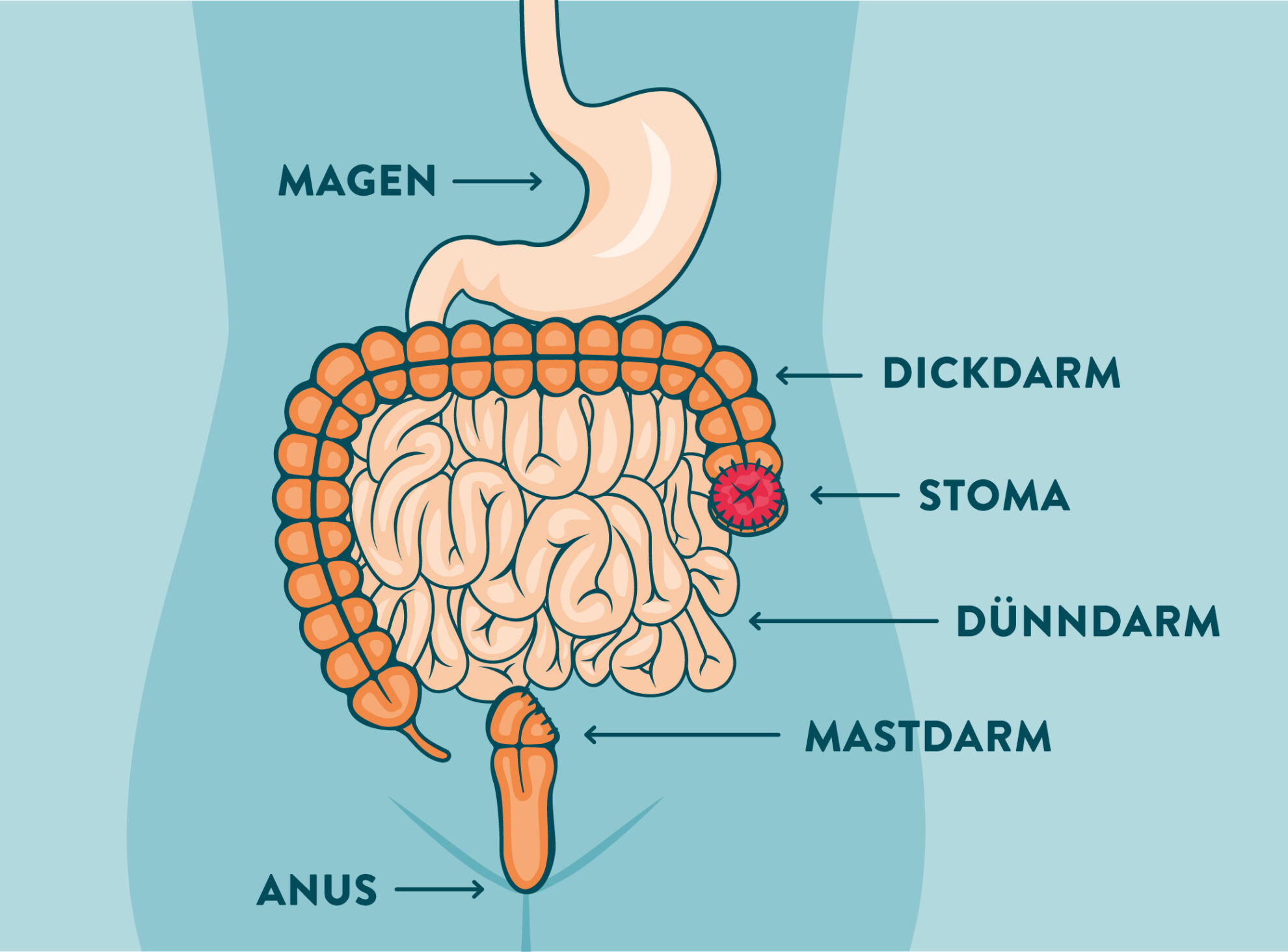 Basisinformationen zum Kolostoma | Selbsthilfe Darmkrebs